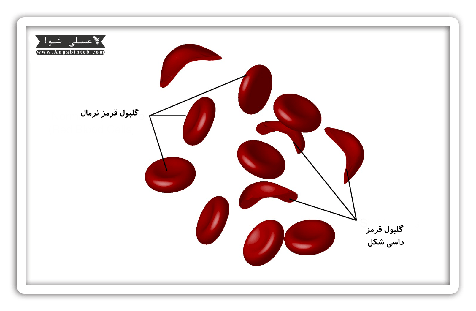 Sickle cell anemia-avarez